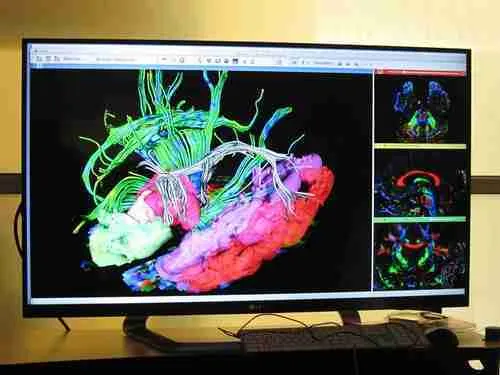 Brain imaging